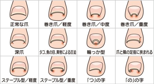 06-4　巻爪矯正　育成前・結果